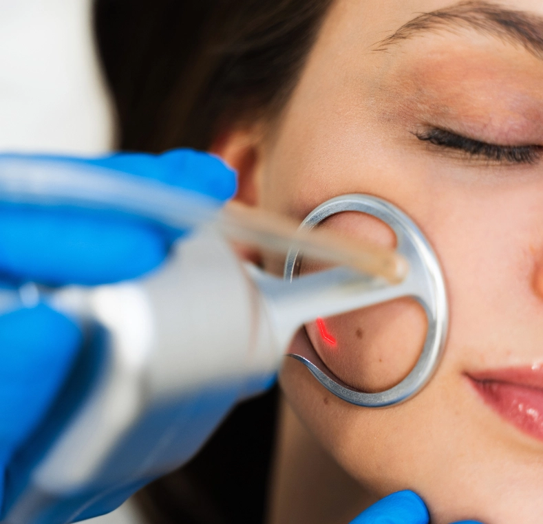 Dermatologist using a laser device to treat a mole on a patient's cheek